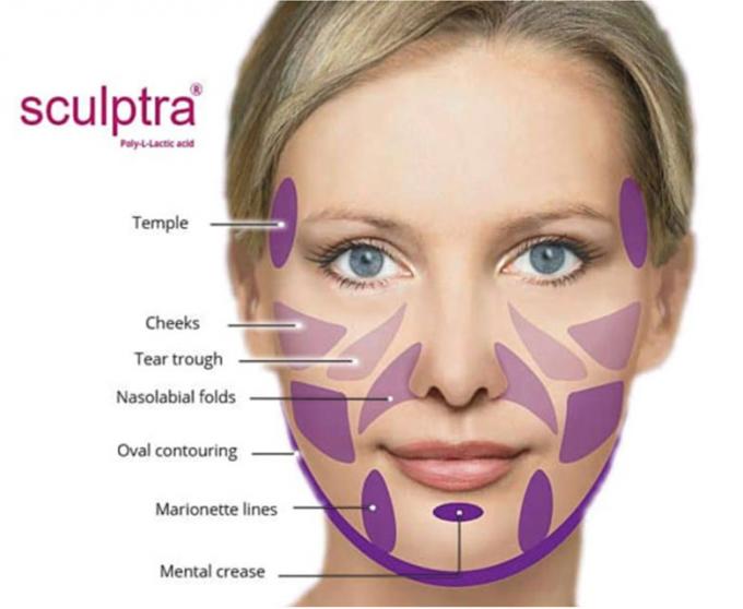Sculptra Skin Lifting • Junglinster, Luxembourg • Advance Aesthetics