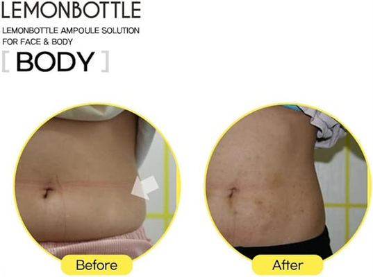 레몬 병 10ml*5 과도한 지방을 녹여 체중을 줄이세요